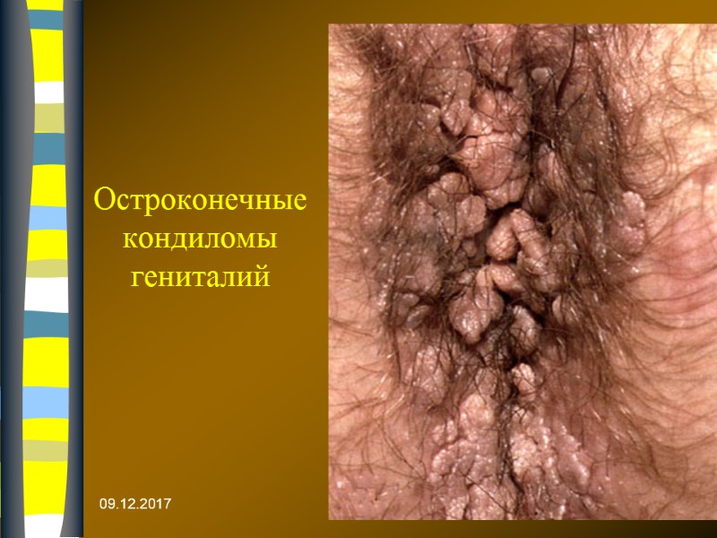 09.12.2017 Остроконечные кондиломы гениталий